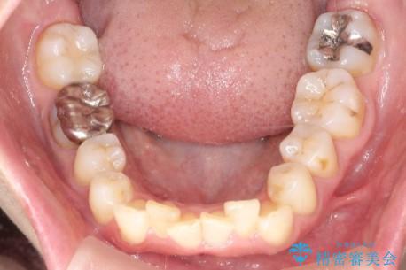 【インビザライン】前歯の凸凹を治したいの治療前