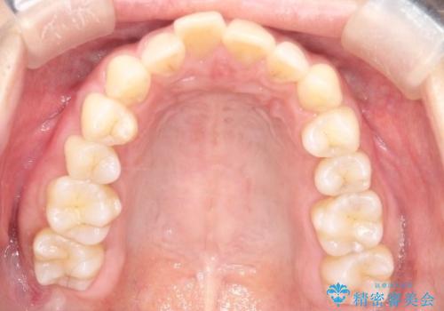 【インビザライン】前歯の凸凹を治したいの治療前