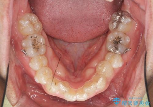2級ディープバイト 遠心移動を伴うマウスピース矯正の治療中