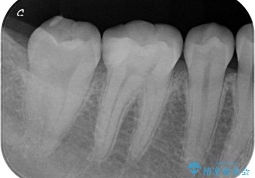 見た目にはわかりにくい奥歯の虫歯　セラミックインレーでの治療の治療後
