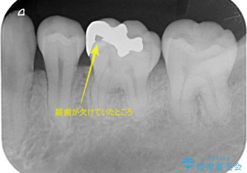 【ハイブリッドインレー】銀歯を白くしたい!の治療前