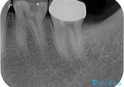 奥歯がしみる 神経を温存する治療の治療後
