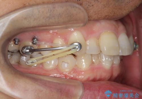 2級ディープバイト 遠心移動を伴うマウスピース矯正の治療中