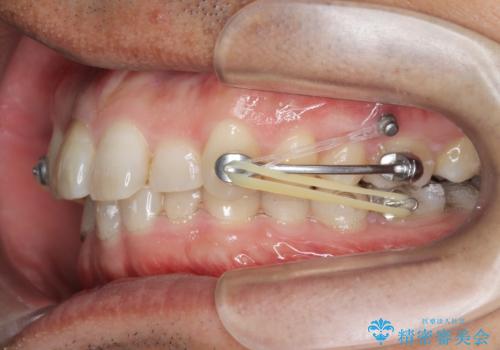 2級ディープバイト 遠心移動を伴うマウスピース矯正の治療中
