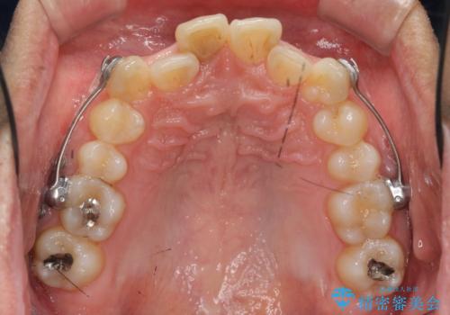 2級ディープバイト 遠心移動を伴うマウスピース矯正の治療中