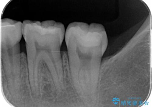 産後の虫歯治療 セラミッククラウンでの治療の治療前