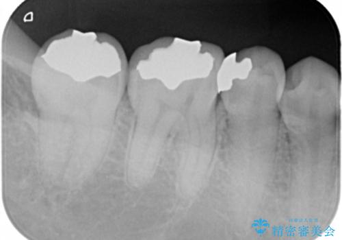銀歯を白くしたい　セラミックインレーでの治療の治療前