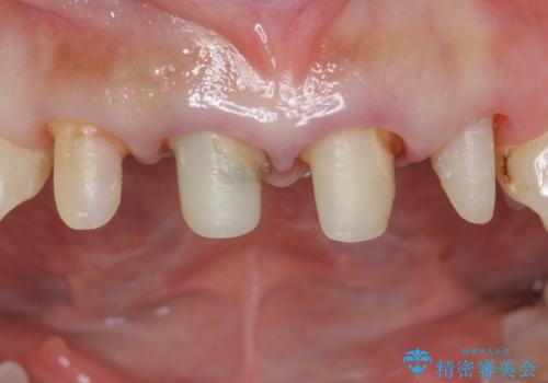 自然な前歯にしたい ジルコニアクラウンでの修復の治療中
