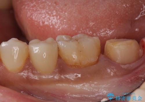 産後の虫歯治療 セラミッククラウンでの治療の治療中