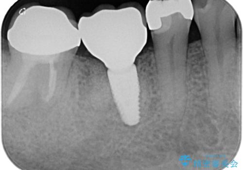 【インプラント】食事中に歯が割れた! かなり深いところまで歯が割れていたの治療後