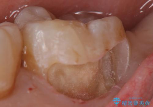 産後の虫歯治療 セラミッククラウンでの治療の治療中