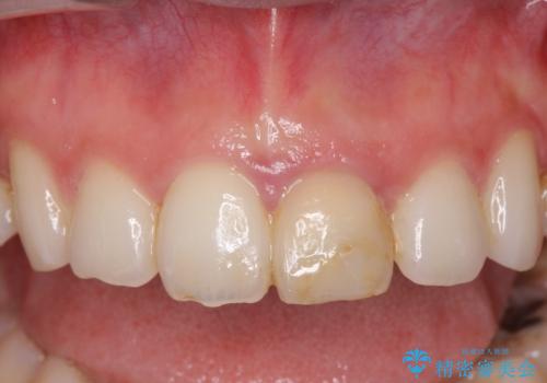 変色してきた前歯をセラミック治療の治療前