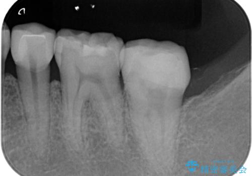 産後の虫歯治療 セラミッククラウンでの治療の治療後