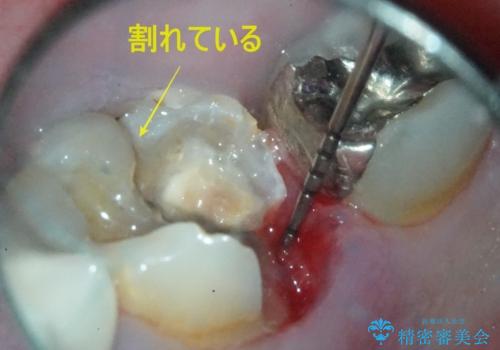 【インプラント】食事中に歯が割れた! かなり深いところまで歯が割れていたの治療前