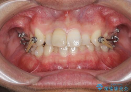 2級ディープバイト 遠心移動を伴うマウスピース矯正の治療中
