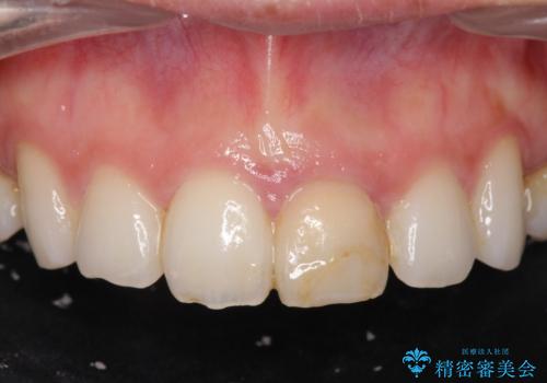 変色してきた前歯をセラミック治療の症例 治療前