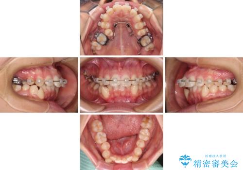 八重歯と乱れた咬み合わせを改善 ワイヤー装置での抜歯矯正の治療中