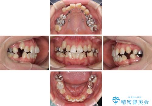 インビザラインが続けられない 装置変更して抜歯矯正の治療中