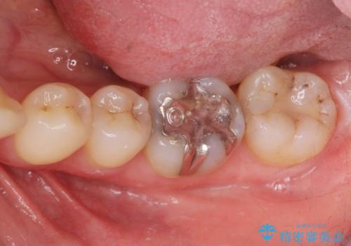 目立つ銀歯をセラミックへの治療前