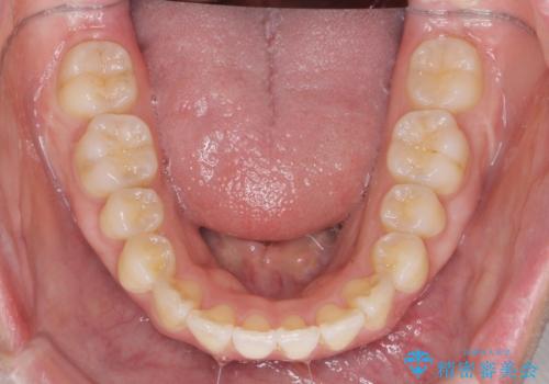 [ マウスピース矯正 ]  出っ歯に見える前歯を改善したいの治療後