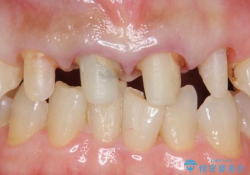 自然な前歯にしたい ジルコニアクラウンでの修復の治療中