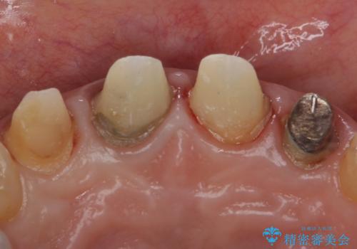自然な前歯にしたい ジルコニアクラウンでの修復の治療中