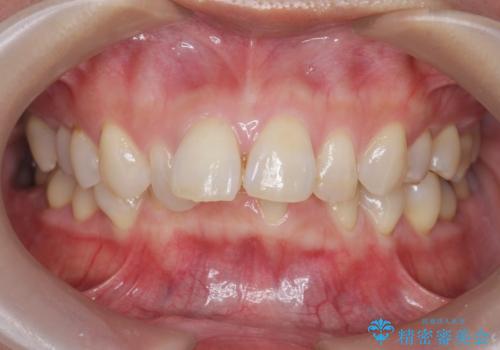 インビザラインで行う前歯のみの部分矯正の治療前