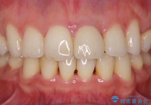変色してきた前歯をセラミック治療の治療後