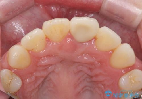 変色してきた前歯をセラミック治療の治療後