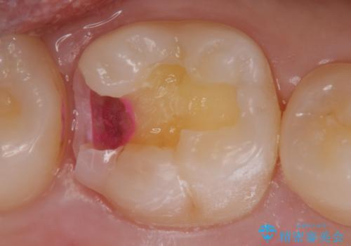 見た目にはわかりにくい奥歯の虫歯 セラミックインレーでの治療の治療中
