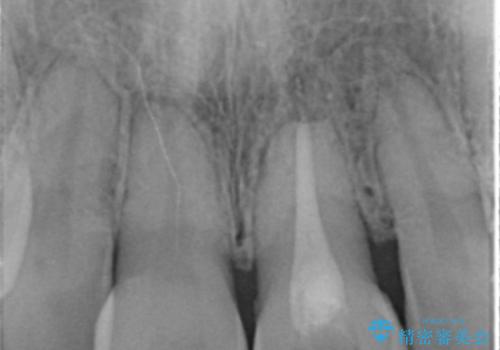 変色してきた前歯をセラミック治療の治療前