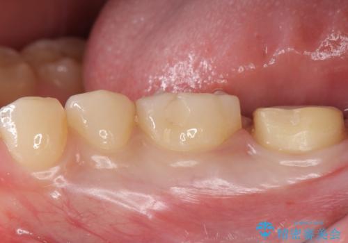 奥歯がしみる 神経を温存する治療の治療中