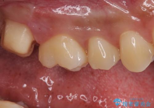 銀歯をなくしたい ジルコニアクラウンでの修復の治療中