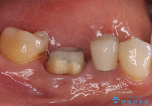 目立つ銀歯を白くしたい ジルコニアクラウンでの修復の治療中