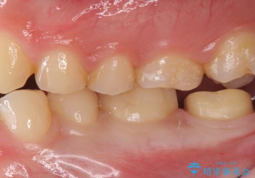 奥歯がしみる 神経を温存する治療の治療中