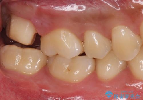 銀歯をなくしたい ジルコニアクラウンでの修復の治療中