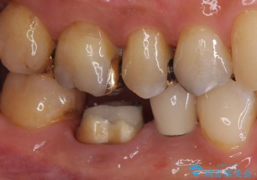 目立つ銀歯を白くしたい ジルコニアクラウンでの修復の治療中