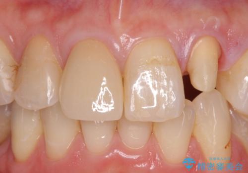 前歯を綺麗にしたい。 ジルコニアクラウンでの修復の治療中