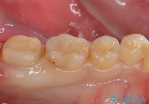 奥歯がしみる 神経を温存する治療の治療中