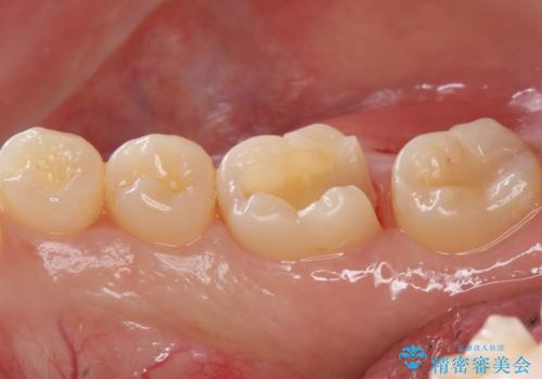 見た目にはわかりにくい奥歯の虫歯 セラミックインレーでの治療の治療中
