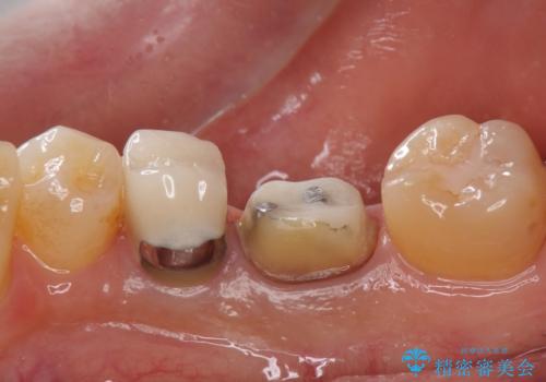 目立つ銀歯を白くしたい ジルコニアクラウンでの修復の治療中