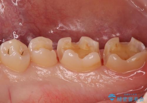 銀歯を白くしたい　セラミックインレーでの治療の治療中