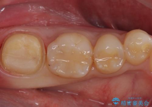奥歯がしみる 神経を温存する治療の治療中