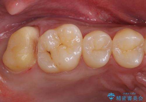 銀歯をなくしたい ジルコニアクラウンでの修復の治療中