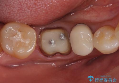 目立つ銀歯を白くしたい ジルコニアクラウンでの修復の治療中