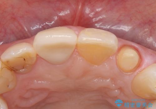 前歯を綺麗にしたい。 ジルコニアクラウンでの修復の治療中