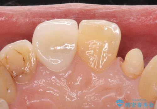 前歯を綺麗にしたい。 ジルコニアクラウンでの修復の治療中