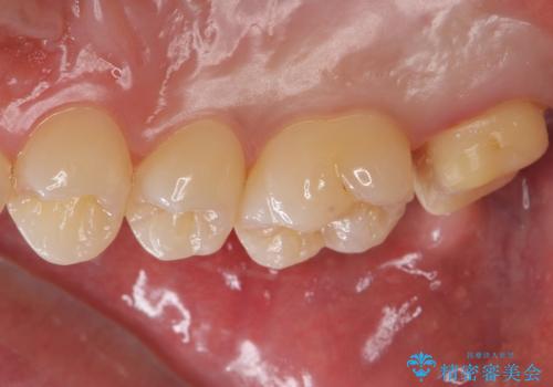 銀歯をなくしたい ジルコニアクラウンでの修復の治療中
