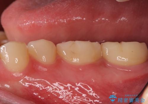 奥歯がしみる 神経を温存する治療の治療後