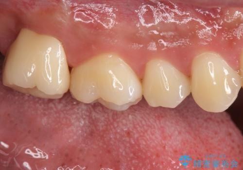 銀歯をなくしたい ジルコニアクラウンでの修復の治療後